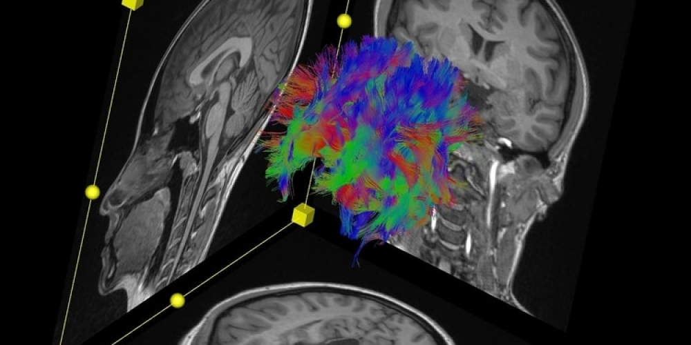 Diffusion Tensor Imaging of the brain