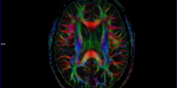 functional MRI Image of Brain